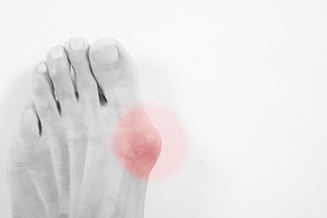 Bunions and Their Causes