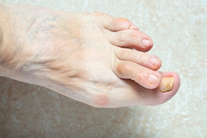 Hammertoe and Its Impact on Foot Mechanics and Plantar Fascia Strain