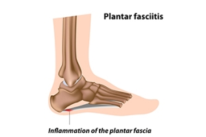 Plantar Fasciitis and Podiatry Care