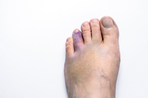 Have I Fractured My Toe?