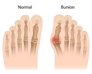 Understanding Bunions and Their Risk Factors