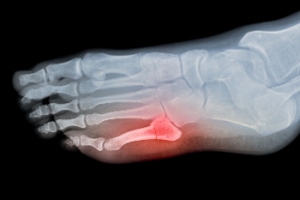 Types of 5th Metatarsal Fractures