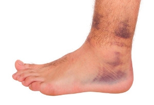 High Ankle Sprain Explained