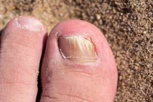 Managing a Fungal Toenail Infection